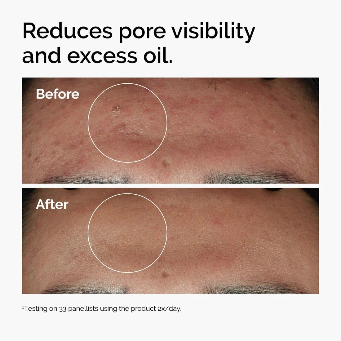Fade Acne Scars Fast: The Ordinary’s Ultimate Scar-Removal Set for Clearer, Smoother Skin!