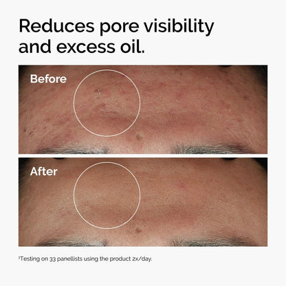 Fade Acne Scars Fast: The Ordinary’s Ultimate Scar-Removal Set for Clearer, Smoother Skin!